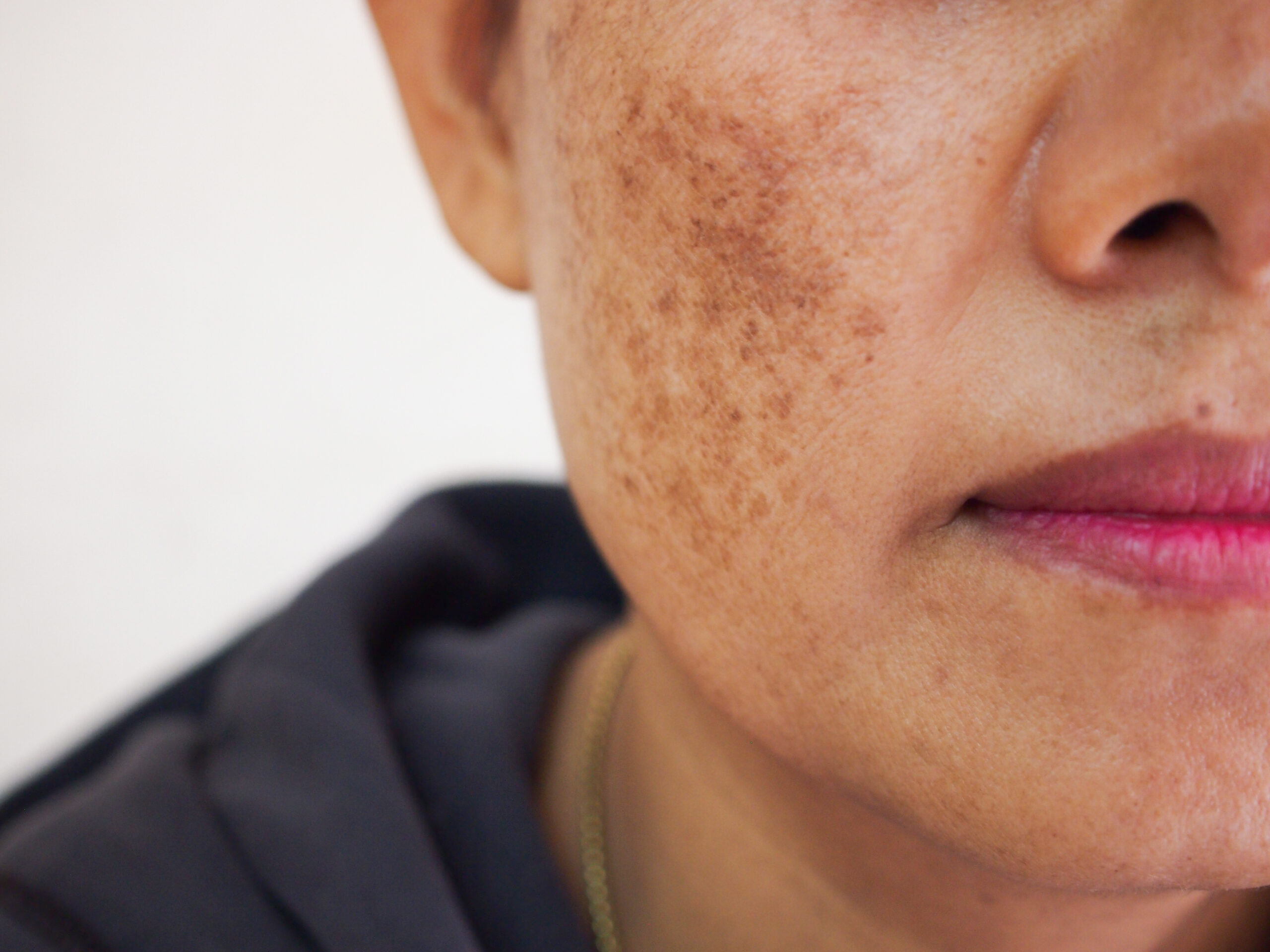 Laser Treatment of Pigmented Spots