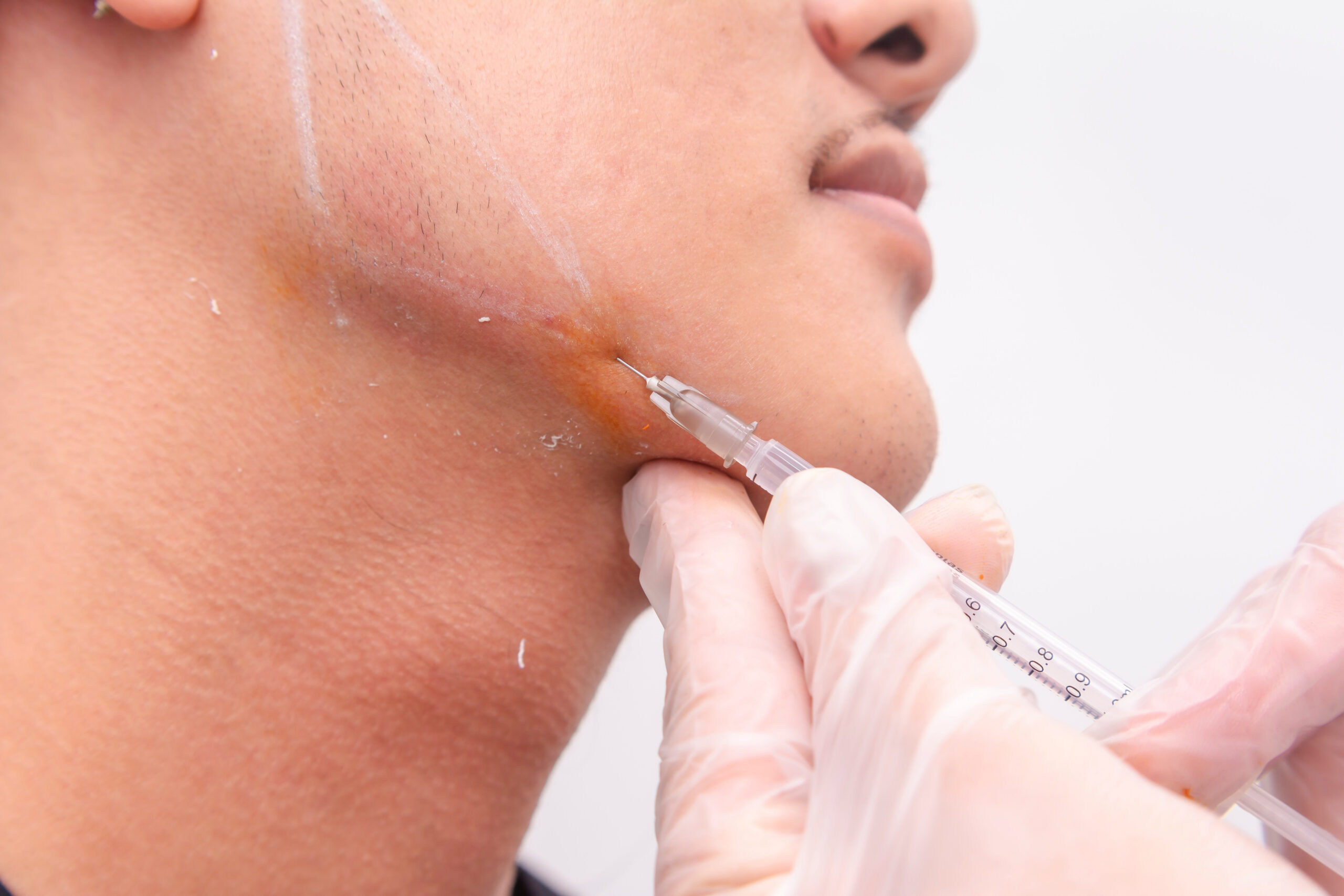 Jawline filler procedure for male patient. Injecting filler gel or hyaluronic acid for a more masculine square jaw look. Done at a esthetic clinic. Services Derm of Cape Cod